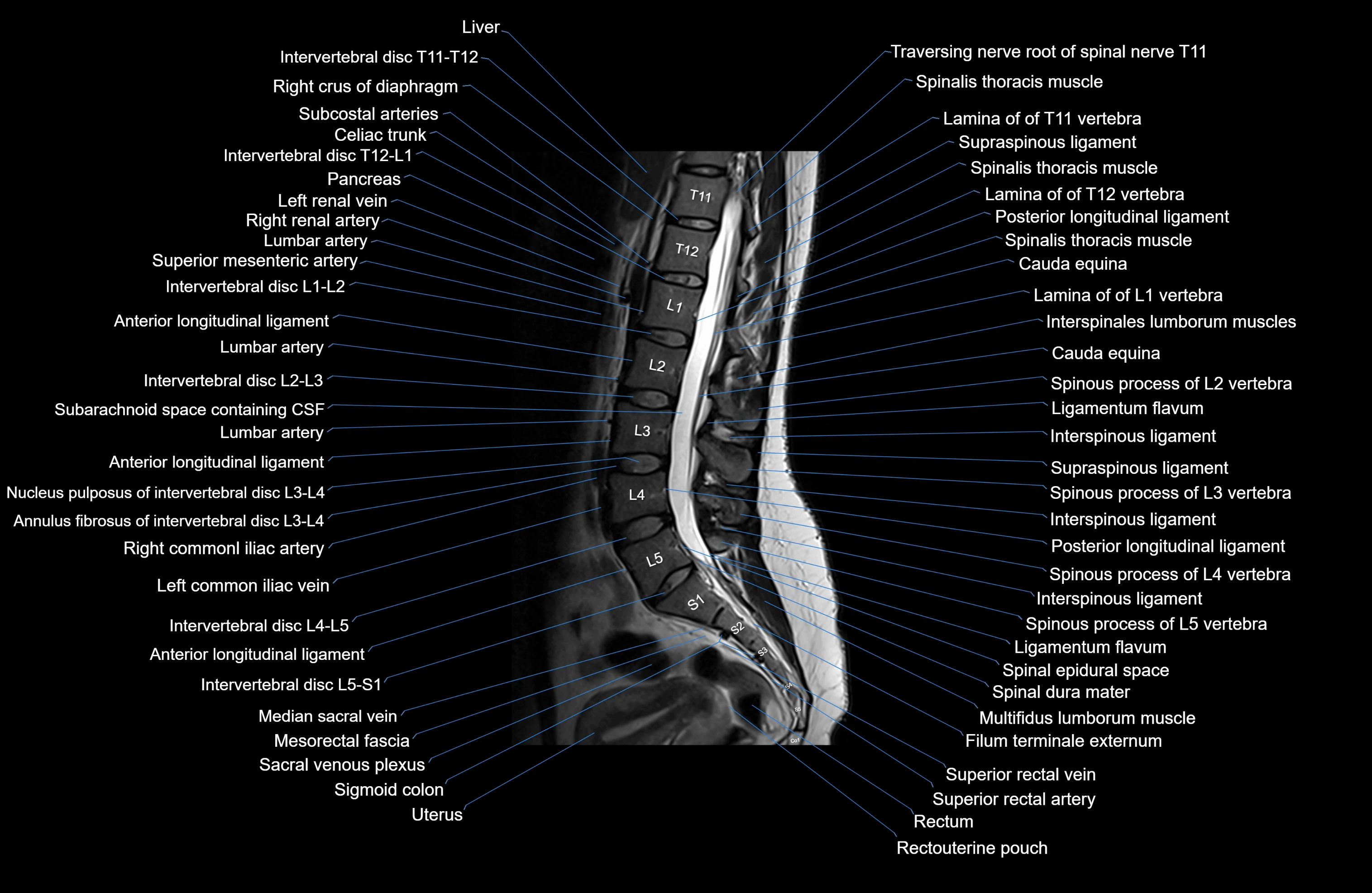 MRI lumbar spine sagittal cross sectional anatomy 3T radiology  image-img-00001-00013.webp